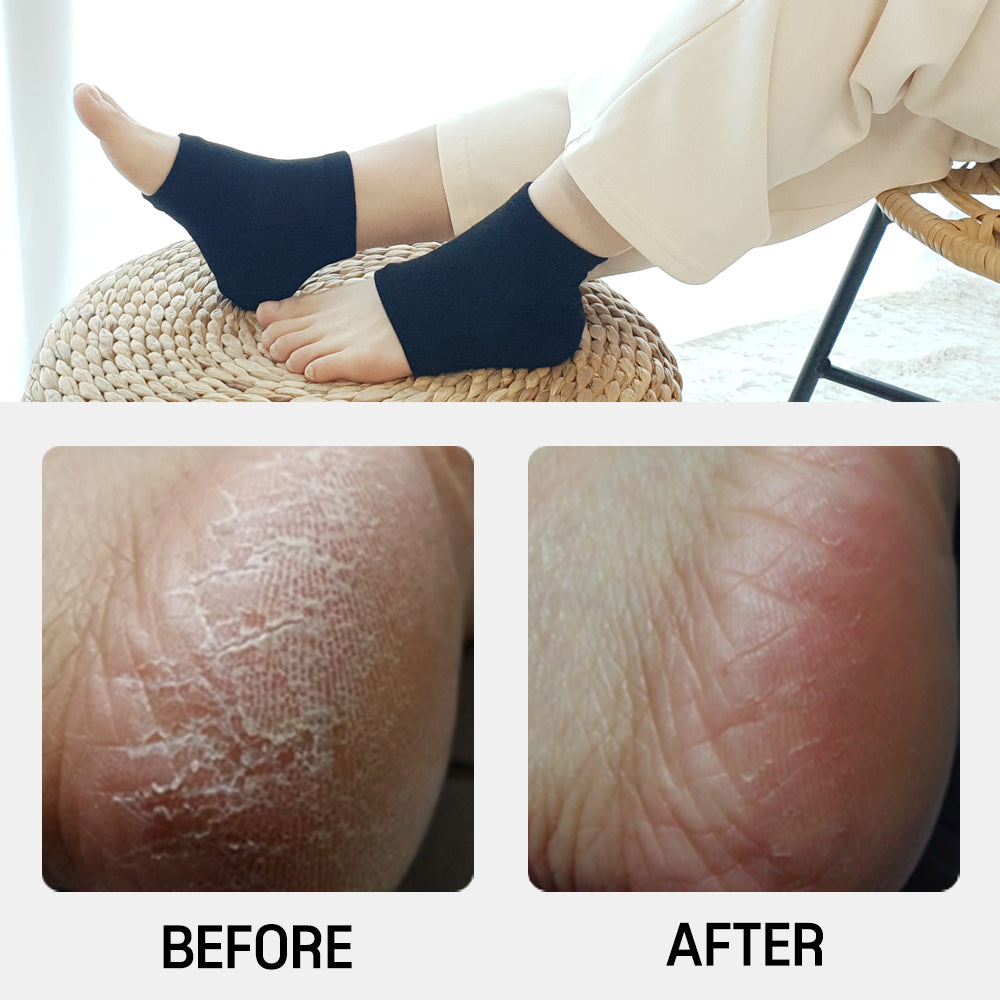 Moisturizing Gel Heel Socks for Men and Women - Open Toe Soft Silicon Sock for Dry Cracked Feet